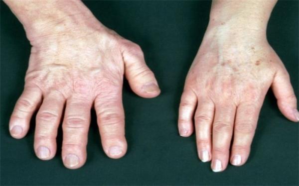 نشانه های عجیب یک بیماری؛ رشد اضافی دست و پاها