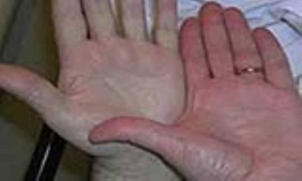 علائم کم خونی شدید علائم کم خونی شدید